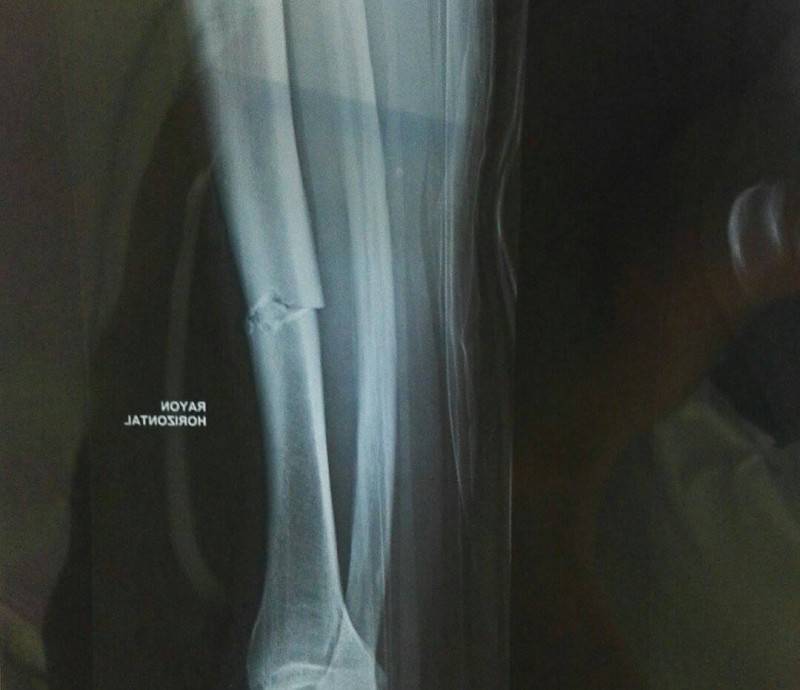 fracture tibia