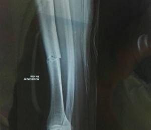 fracture tibia - cahors