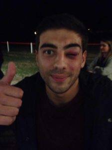 robin de macedo rdm arcade ouverte 7 pts de suture mais plaquage reussi 1 - insolites