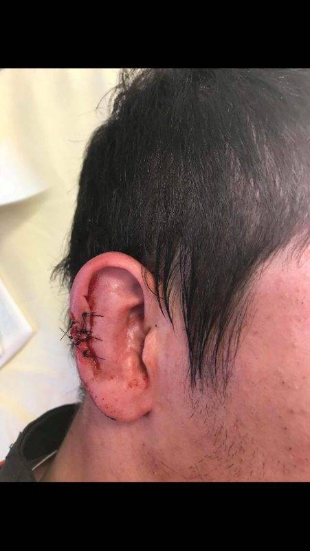 Guillaume barranger UA saverdun pas une morsure, juste un coup de casque 3ème ligne