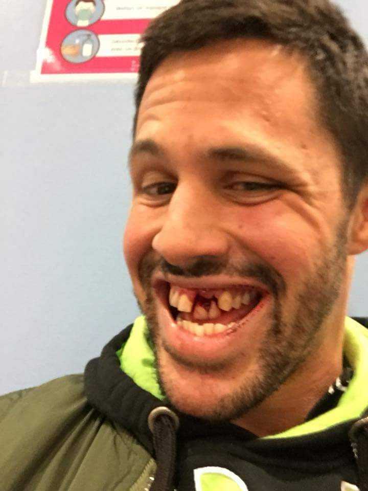 benji casta de quint, générale sans protege deux dents en moins