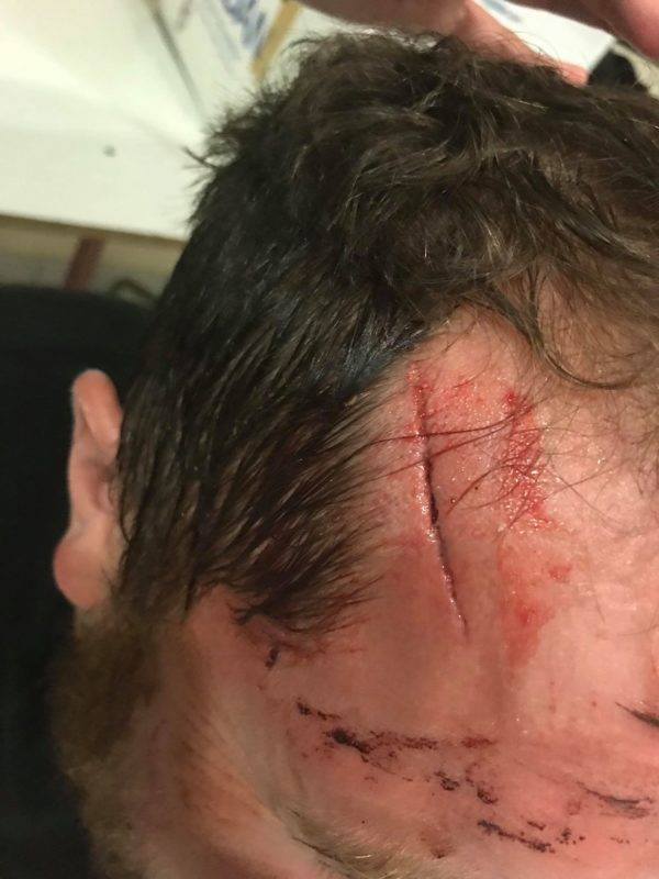 L’ouvreur de Septfonds Romain Monticone s’est amicalement fais chausser au sollors du match contre Haute vallée de l’Aveyron