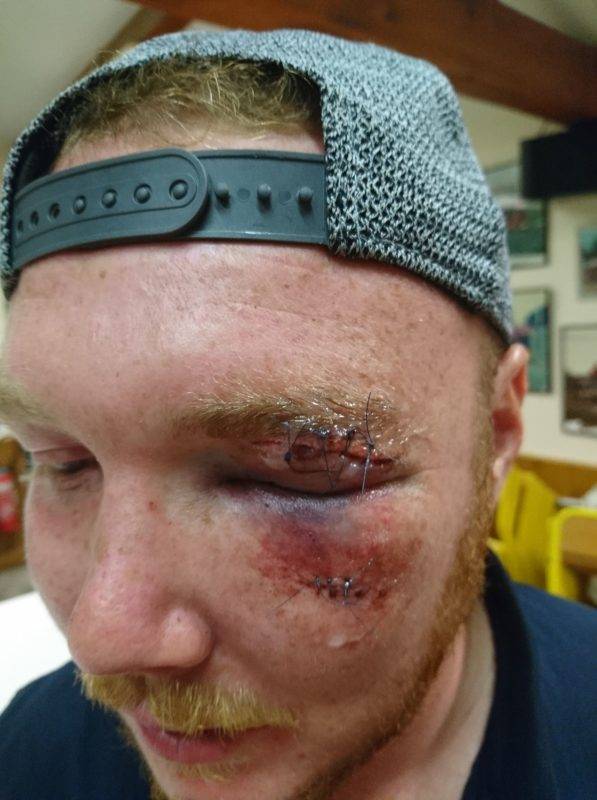 Mafré du week end, Romain Gendry, Sainte Foy De Peyrolieres. Blessure occasionnée par son coéquipier Julien Clamont.