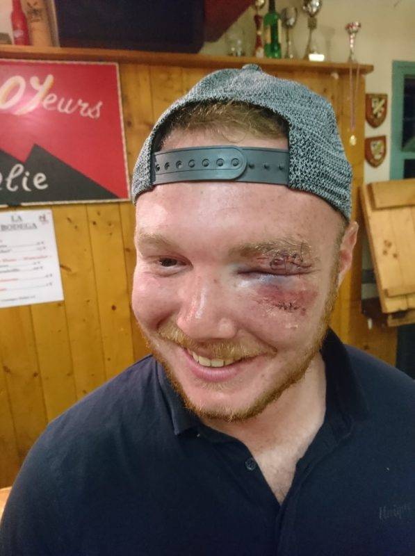 Maffré du week end, Romain Gendry, Sainte Foy De Peyrolieres. Blessure occasionnée par son coéquipier Julien Clamont