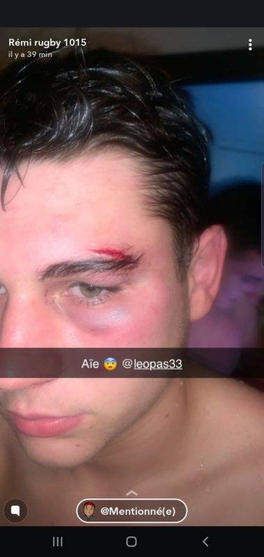 Leo qui joue à l'eab c'est fais cassé l'arcade sur une bagarre lor du match eab bagnères de Bigorre